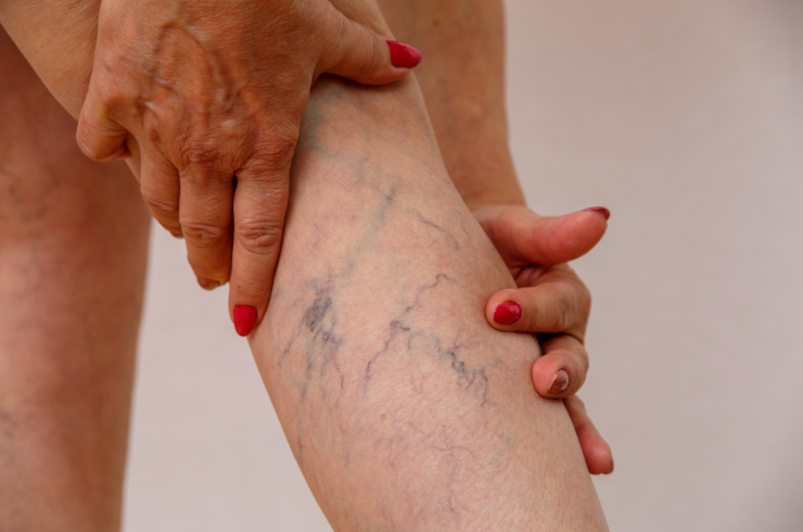 Vascular Intervention
